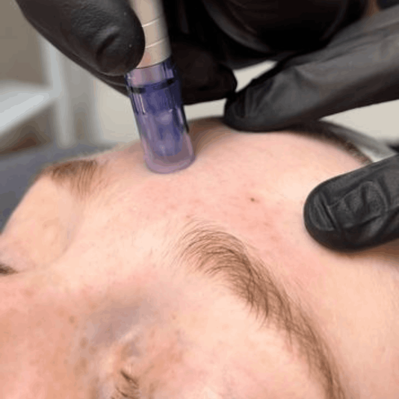 Clínica de Estética Microagulhamento BH