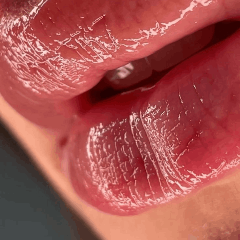 Clínica Estética Preenchimento Labial BH